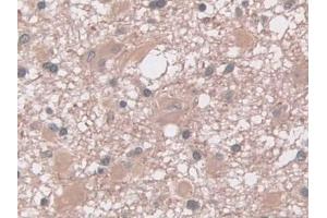 DAB staining on IHC-P; Samples: Human Glioma Tissue (Interferon gamma anticorps  (AA 24-166))
