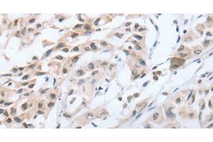 Immunohistochemistry of paraffin-embedded Human lung cancer tissue using CHRNA10 Polyclonal Antibody at dilution 1:50 (CHRNA10 anticorps)