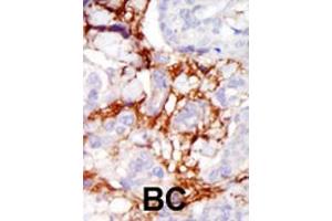 Formalin-fixed and paraffin-embedded human cancer tissue reacted with the primary antibody, which was peroxidase-conjugated to the secondary antibody, followed by AEC staining.