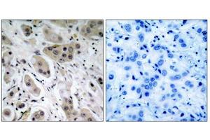 Immunohistochemical analysis of paraffin- embedded breast carcinoma, using Akt (Phospho-Ser473) Antibody. (AKT1 anticorps  (pSer473))
