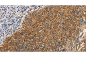 Immunohistochemistry of paraffin-embedded Human cervical cancer tissue using ERK 3 Polyclonal Antibody at dilution 1:40