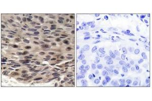 Immunohistochemical analysis of paraffin-embedded human breast carcinoma, using 4E-BP1 (phospho-Thr36) antibody. (eIF4EBP1 anticorps  (pThr36))