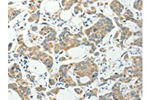 The image on the left is immunohistochemistry of paraffin-embedded Human colon cancer tissue using ABIN7191847(PFDN6 Antibody) at dilution 1/35, on the right is treated with synthetic peptide. (PFDN6 anticorps)