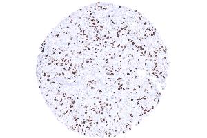 High Ki67 LI in a breast cancer NST (Ki-67 anticorps  (AA 2293-2478))