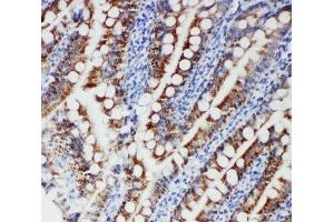 IHC-P: FER antibody testing of human intestinal cancer tissue