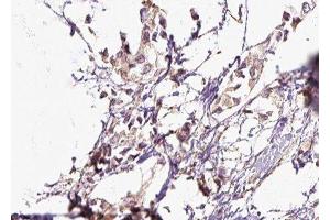 ABIN6276543 at 1/100 staining Human breast cancer tissue by IHC-P. (RALBP1 anticorps  (N-Term))