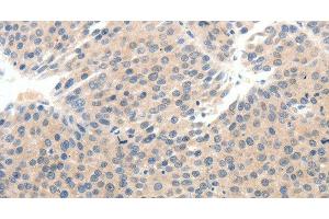 Immunohistochemistry of paraffin-embedded Human breast cancer tissue using SCN10A Polyclonal Antibody at dilution 1:25 (Nav1.8 anticorps)