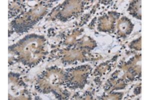 The image on the left is immunohistochemistry of paraffin-embedded Human colon cancer tissue using ABIN7191092(IMPAD1 Antibody) at dilution 1/20, on the right is treated with synthetic peptide. (IMPAD1 anticorps)