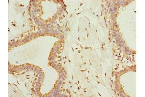 Immunohistochemistry of paraffin-embedded human breast cancer using ABIN7173083 at dilution of 1:100 (TMEM161A anticorps  (AA 29-98))