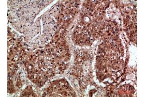 Immunohistochemical analysis of paraffin-embedded human-lung-cancer, antibody was diluted at 1:200 (TICAM1 anticorps  (AA 663-712))