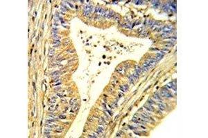 IHC analysis of FFPE human colon carcinoma stained with SOD1 antibody