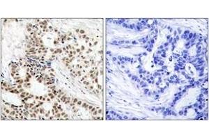 Immunohistochemistry analysis of paraffin-embedded human breast carcinoma, using BRCA1 (Phospho-Ser1423) Antibody. (BRCA1 anticorps  (pSer1423))