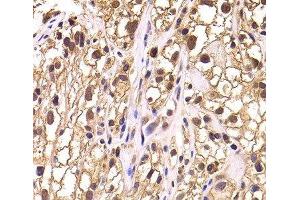 Immunohistochemistry of paraffin-embedded Human kidney cancer using TCEB3 Polyclonal Antibody at dilution of 1:100 (40x lens). (TCEB3 anticorps)