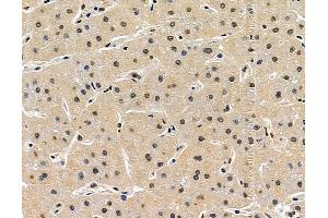 ABIN7097035 and ABIN7101102 at 1/100 staining human liver cancer and adjacent non-tumor tissue by IHC-P.