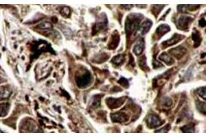 Immunohistochemistry of RFFL polyclonal antibody  shows strong cytoplasmic and membranous staining of tumor cells in cancerous human liver tissue.
