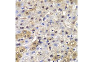 Immunohistochemistry of paraffin-embedded human liver cancer using MAD1L1 antibody. (MAD1L1 anticorps  (AA 360-700))