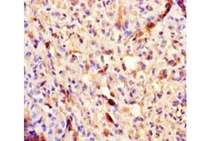 Immunohistochemistry of paraffin-embedded human melanoma using ABIN7154460 at dilution of 1:100 (PLA2G2D anticorps  (AA 22-145))