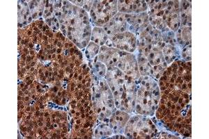 Immunohistochemical staining of paraffin-embedded Adenocarcinoma of colon tissue using anti-SRR mouse monoclonal antibody. (SRR anticorps)