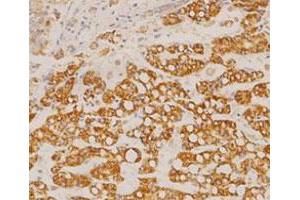 Immunohistochemical staining of human liver cancer tissue section with GOT2 monoclonal antibody, clone 14  at 1:100 dilution. (GOT2 anticorps  (AA 225-430))