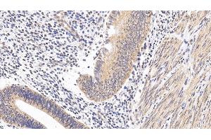 Detection of MAPK14 in Human Endometrial cancer Tissue using Polyclonal Antibody to Mitogen Activated Protein Kinase 14 (MAPK14)