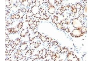 Formalin-fixed, paraffin-embedded human thyroid stained with TTF1 antibody (NX2. (TTF1 anticorps)