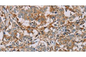 Immunohistochemistry of paraffin-embedded Human liver cancer tissue using CD204 Polyclonal Antibody at dilution of 1:30 (Macrophage Scavenger Receptor 1 anticorps)