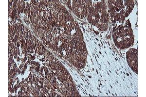 Immunohistochemical staining of paraffin-embedded Adenocarcinoma of Human ovary tissue using anti-LIMK1 mouse monoclonal antibody. (LIM Domain Kinase 1 anticorps)