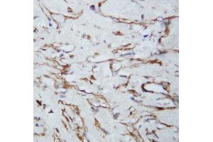 Anti-VEGF antibody, IHC(P) IHC(P): Human Lung Cancer Tissue (VEGFA anticorps  (N-Term))