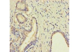 Immunohistochemistry of paraffin-embedded human prostate cancer using ABIN7173007 at dilution of 1:100 (TMPRSS11D anticorps  (AA 201-418))