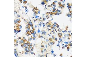 Immunohistochemistry of paraffin-embedded human lung cancer using F antibody (ABIN3016158, ABIN3016159, ABIN3016160 and ABIN6219586) at dilution of 1:100 (40x lens). (APOBEC3F anticorps  (AA 1-65))