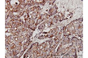 Immunoperoxidase of monoclonal antibody to GBA on formalin-fixed paraffin-embedded human breast cancer.