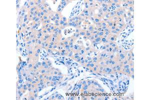 Immunohistochemistry of Human lung cancer using NUAK1 Polyclonal Antibody at dilution of 1:60 (NUAK1 anticorps)