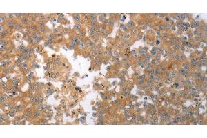Immunohistochemistry of paraffin-embedded Human breast cancer tissue using SHH Polyclonal Antibody at dilution 1:40 (Sonic Hedgehog anticorps)