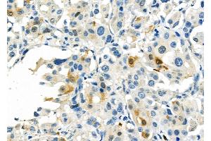 ABIN6260628 and ABIN6276794 at 1/100 staining Human lung cancer by IHC-P.