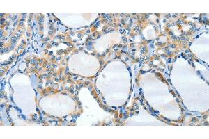 Immunohistochemistry of paraffin-embedded Human thyroid cancer tissue using HID1 Polyclonal Antibody at dilution 1:50