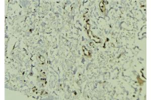 ABIN6272454 at 1/100 staining Human breast cancer tissue by IHC-P. (Cytidine Monophosphate (UMP-CMP) Kinase 1, Cytosolic (CMPK1) (N-Term) anticorps)