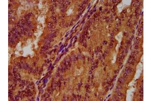 IHC image of ABIN7162774 diluted at 1:300 and staining in paraffin-embedded human endometrial cancer performed on a Leica BondTM system. (PGLYRP1 anticorps  (AA 22-196))