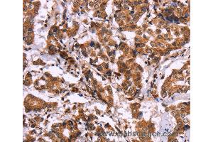 Immunohistochemistry of Human liver cancer using CARD11 Polyclonal Antibody at dilution of 1:40 (CARD11 anticorps)