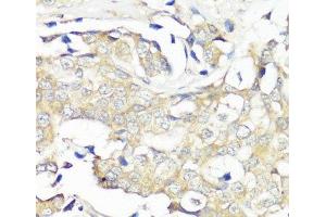 Immunohistochemistry of paraffin-embedded Human breast cancer using EIF3B Polyclonal Antibody at dilution of 1:100 (40x lens). (EIF3B anticorps)
