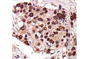 IHC analysis of FFPE human breast carcinoma tissue stained with the PKC nu antibody (PRKD3 anticorps  (AA 352-384))