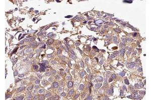ABIN6267700 at 1/100 staining human breast carcinoma tissue sections by IHC-P.