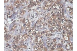 Detection of NT-ProBNP in Human Breast cancer Tissue using Polyclonal Antibody to N-Terminal Pro-Brain Natriuretic Peptide (NT-ProBNP)