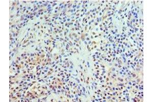 Immunohistochemistry of paraffin-embedded human breast cancer using ABIN7172022 at dilution of 1:100