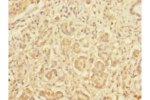 Immunohistochemistry of paraffin-embedded human pancreatic cancer using ABIN7165266 at dilution of 1:100