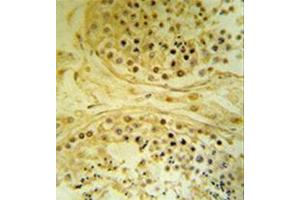 Immunohistochemistry analysis in formalin fixed and paraffin embedded human testis carcinoma reacted with  BXDC4 / IMP4 Antibody (C-term) followed by peroxidase conjugation of the secondary antibody and DAB staining. (IMP4 anticorps  (C-Term))