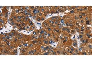 Immunohistochemistry of paraffin-embedded Human liver cancer tissue using CATSPER3 Polyclonal Antibody at dilution 1:60 (CATSPER3 anticorps)