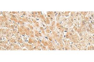 Immunohistochemistry of paraffin-embedded Human liver cancer tissue using TRUB1 Polyclonal Antibody at dilution of 1:85(x200) (TRUB1 anticorps)