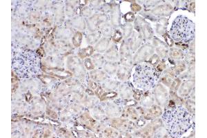 IHC analysis of GST3 / GST pi using anti-GST3 / GST pi antibody . (GSTP1 anticorps  (AA 2-210))