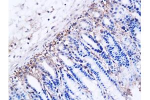 Formalin-fixed and paraffin embedded human breast carcinoma labeled with Anti DBC2 Polyclonal Antibody, Unconjugated (ABIN706241) at 1:200 followed by conjugation to the secondary antibody and DAB staining (RHOBTB2 anticorps  (AA 631-727))