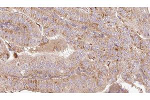 ABIN6267191 at 1/100 staining Human thyroid cancer tissue by IHC-P. (tau anticorps  (pSer199))